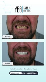before-after photo tooth-extraction