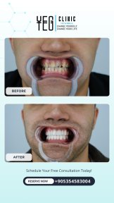 before-after photo tooth-extraction