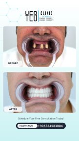 before-after photo tooth-extraction