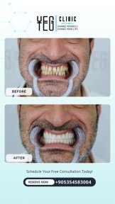 before-after photo tooth-extraction