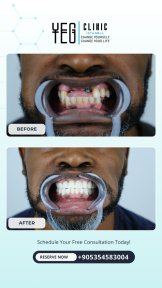 before-after photo tooth-extraction