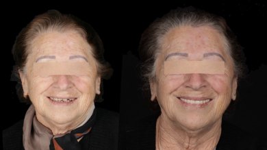 before-after photo all-on-4-dental-implants