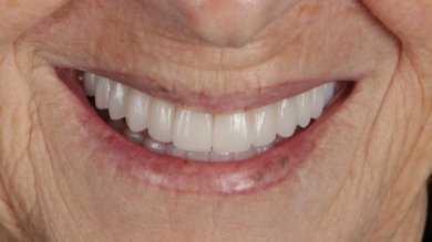 before-after photo all-on-4-dental-implants