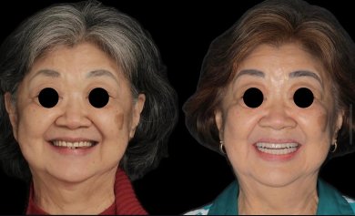 before-after photo all-on-4-dental-implants