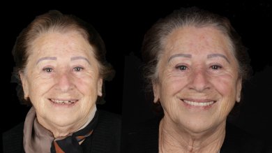 before-after photo all-on-6-dental-implants