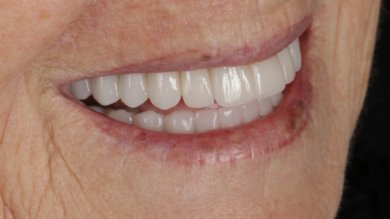 before-after photo all-on-6-dental-implants