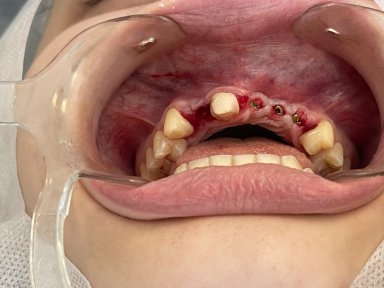 before-after photo all-on-6-dental-implants