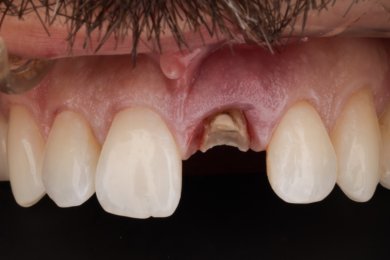 before-after photo dental-implant
