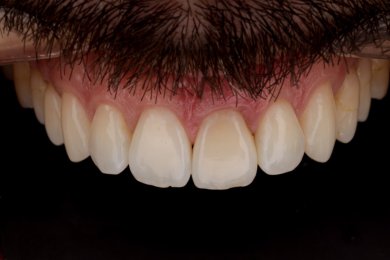 before-after photo dental-implant