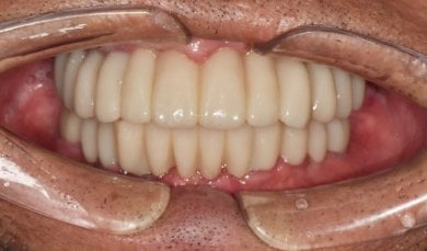 before-after photo all-on-6-dental-implants