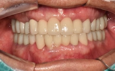 before-after photo all-on-6-dental-implants