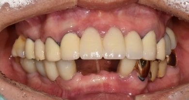 before-after photo all-on-6-dental-implants