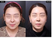 Efekty liftingu twarzy przed i po w VG Plastic Surgery – odmłodzenie i poprawa konturu