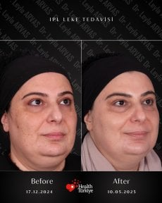 Before and after IPL skin treatment at Quartz Hospital – improved facial pigmentation results