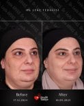 Before and after IPL skin treatment at Quartz Hospital – improved facial pigmentation results