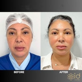 Результаты до и после подтяжки лица в ID Clinic Bangkok, видимое омоложение и лифтинг