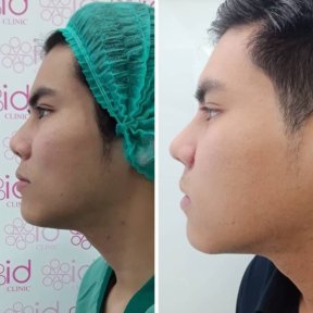 Результаты этнической ринопластики до и после в ID Clinic Bangkok, улучшенный профиль носа