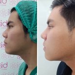 Результаты этнической ринопластики до и после в ID Clinic Bangkok, улучшенный профиль носа