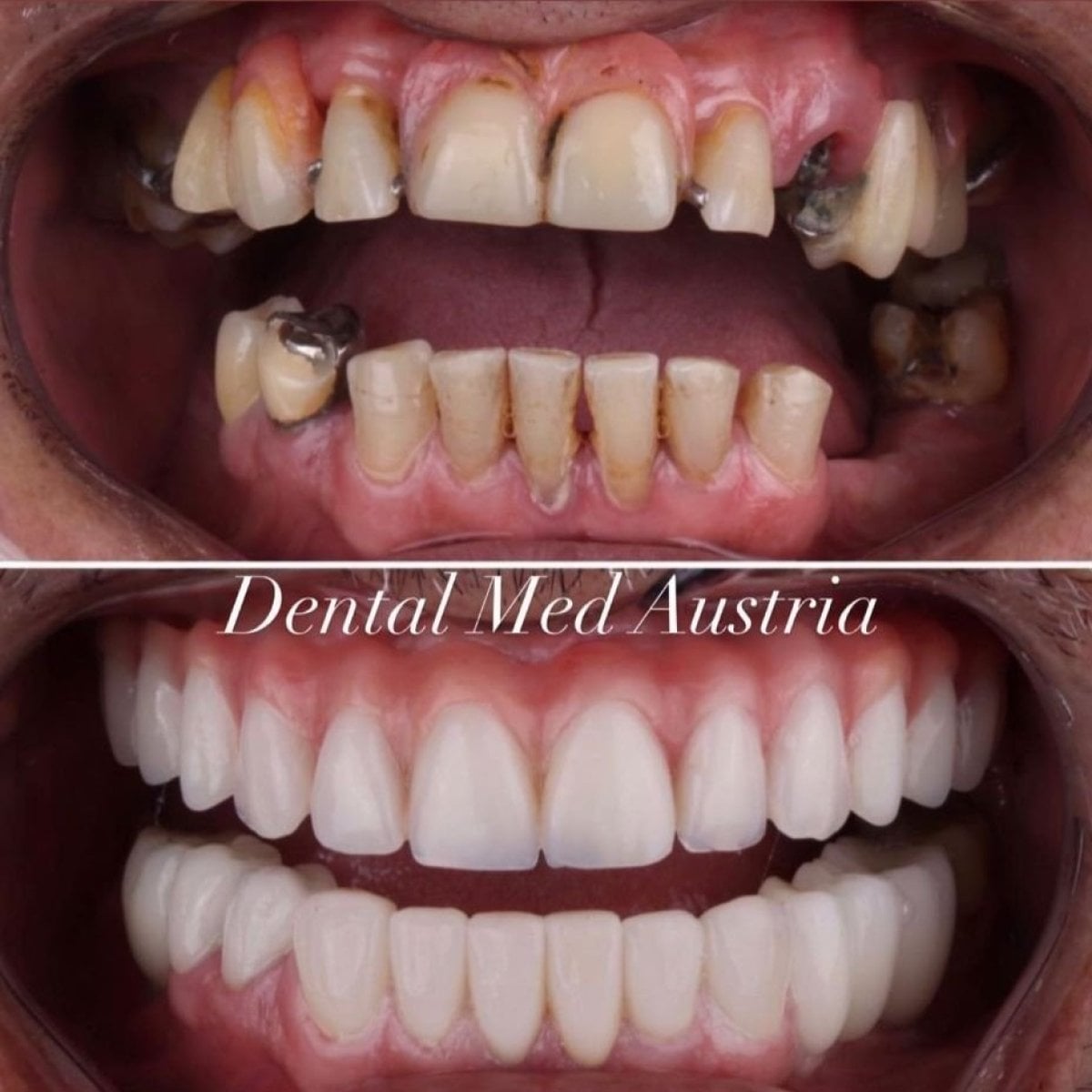Resultados antes y después de implantes dentales All-on-6 en Dental Med Austria & Elixence