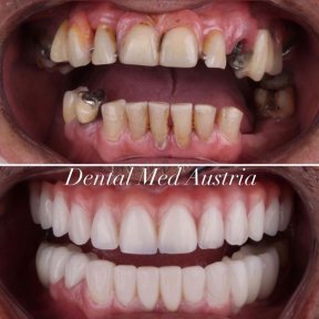 before-after photo all-on-6-dental-implants
