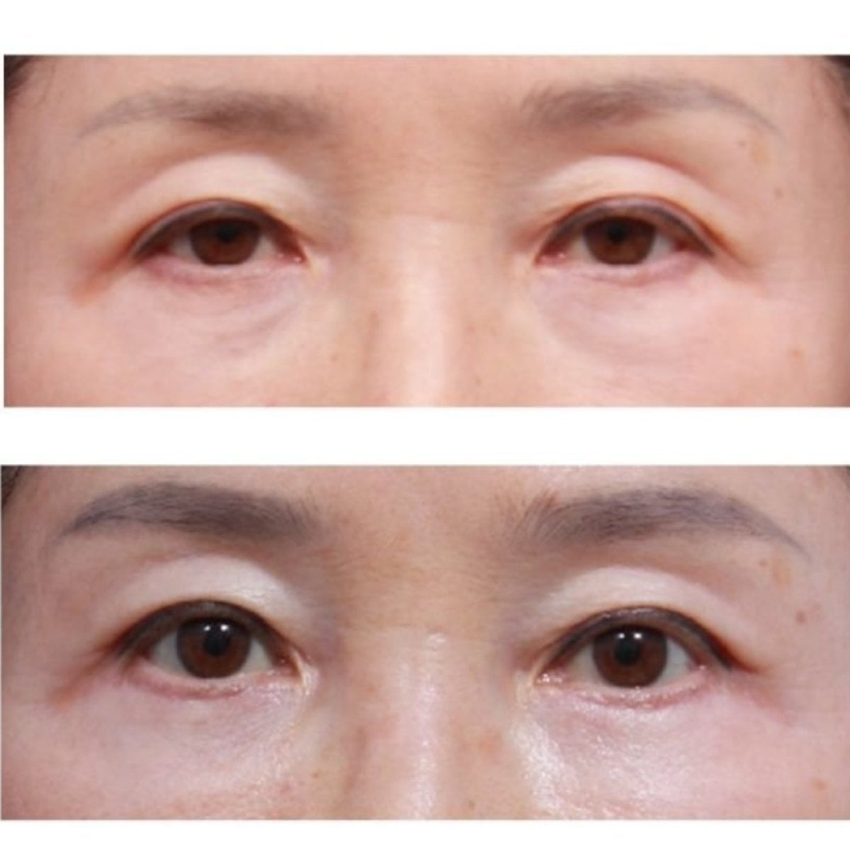 نتائج شد الجفن السفلي قبل وبعد في عيادة Returning Plastic Surgery