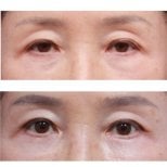 Vorher-nachher-Ergebnis der Unterlid-Blepharoplastik bei Returning Plastic Surgery
