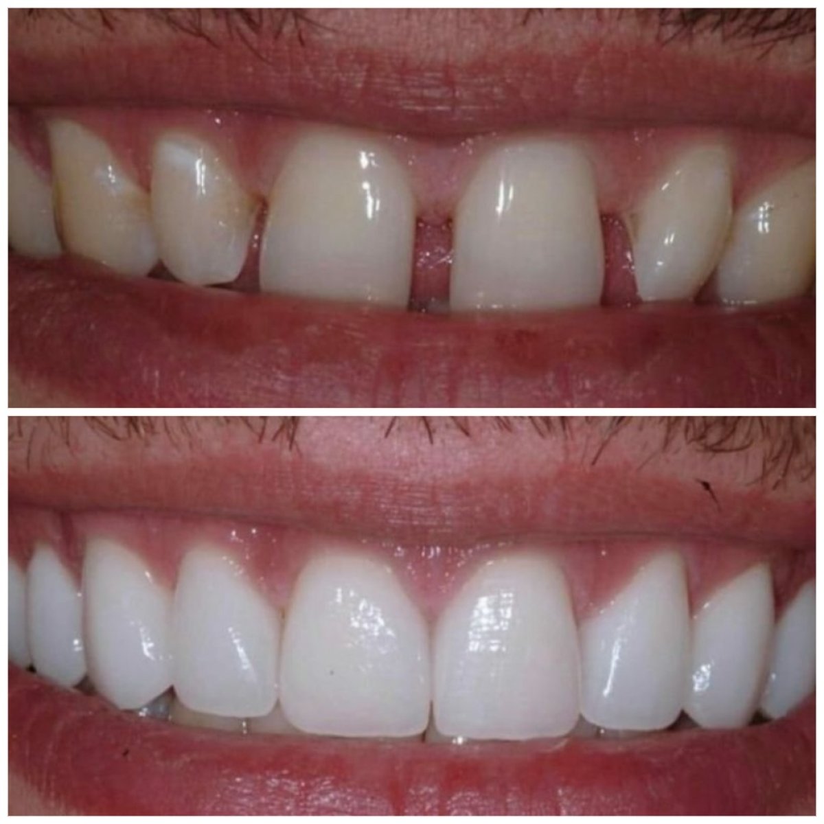 Resultados antes y después de bonding dental para restauración de sonrisa en Santa Caterina