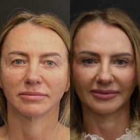 Resultados de lifting endoscópico facial antes y después en Artisan Clinic, rejuvenecimiento