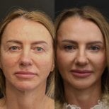 Resultados de lifting endoscópico facial antes y después en Artisan Clinic, rejuvenecimiento