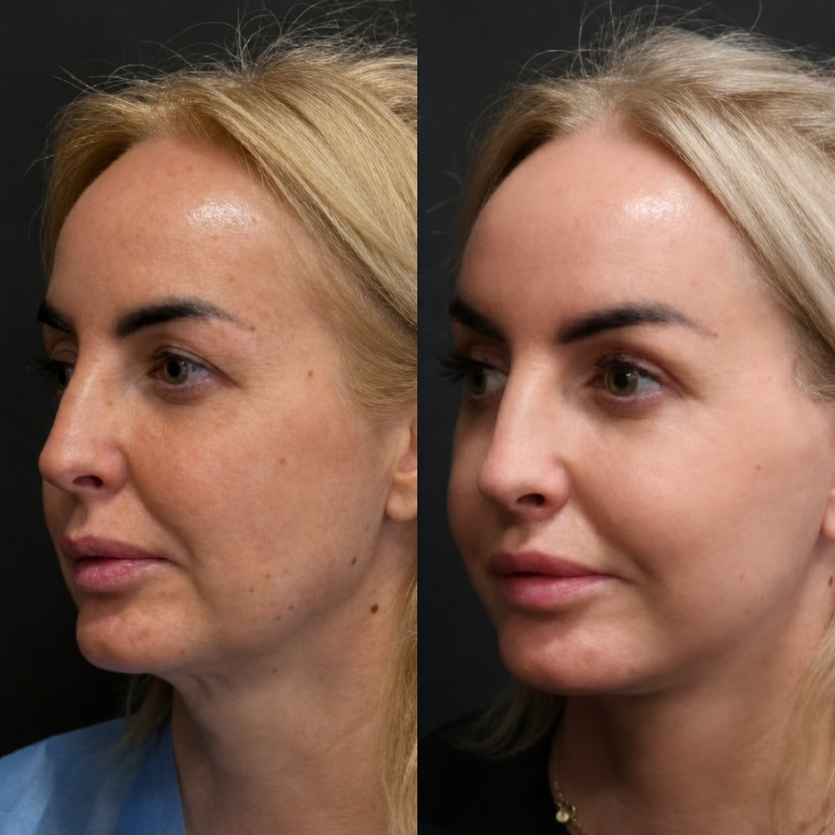 Resultados de lifting endoscópico facial antes y después en Artisan Clinic, rejuvenecimiento