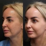 Resultados de lifting endoscópico facial antes y después en Artisan Clinic, rejuvenecimiento