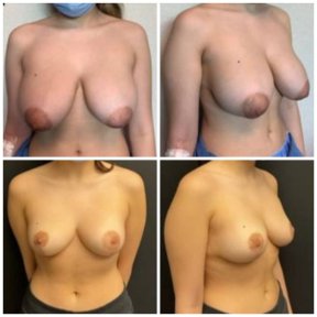 before-after photo mastopexy-breast-lift-contour-plastics