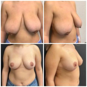 before-after photo mastopexy-breast-lift-contour-plastics