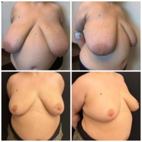 before-after photo mastopexy-breast-lift-contour-plastics