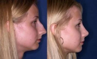 نتائج تجميل الأنف قبل وبعد، إعادة تشكيل الأنف لتحسين ملامح الوجه