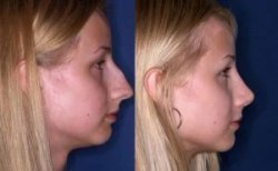 نتائج تجميل الأنف قبل وبعد، إعادة تشكيل الأنف لتحسين ملامح الوجه