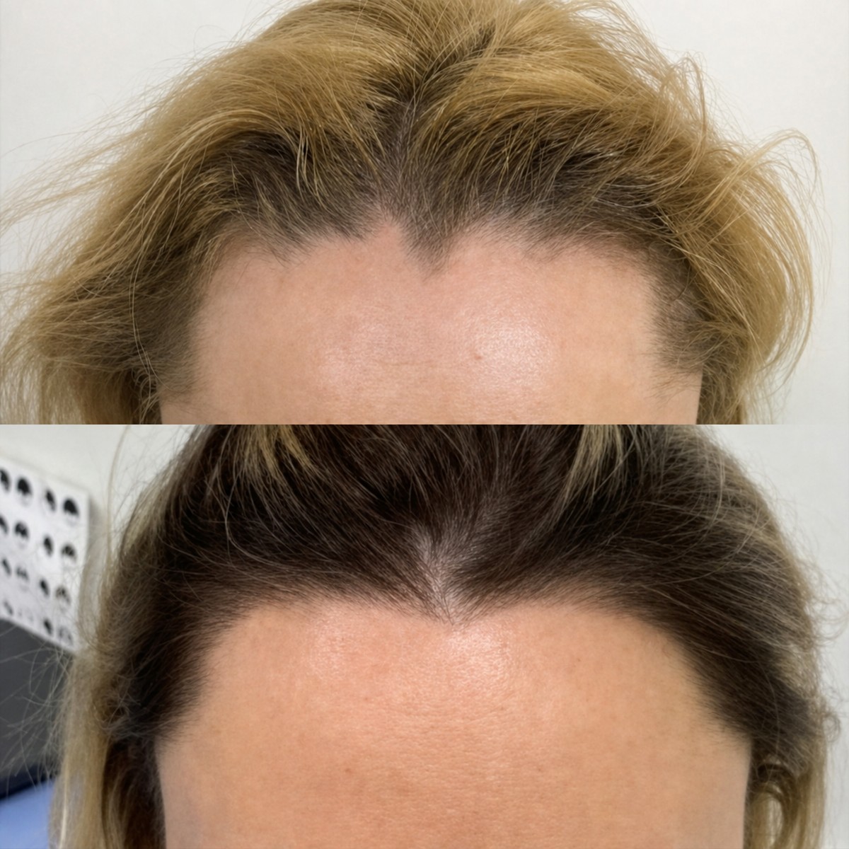 نتيجة زراعة الشعر للنساء في Hair Clinic PRIVÉ – استعادة خط الشعر الأمامي