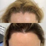 Résultat avant/après greffe de cheveux femme à Hair Clinic PRIVÉ – ligne restaurée