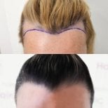 Résultat greffe de cheveux femme avant-après à Hair Clinic PRIVÉ – ligne capillaire restaurée