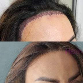 Résultats avant/après greffe de cheveux femme à Hair Clinic PRIVÉ, ligne restaurée