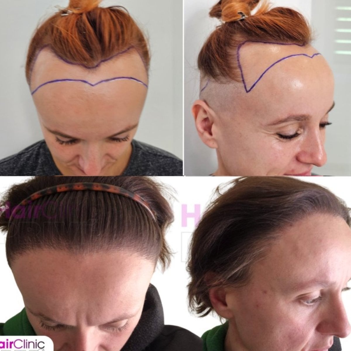 Resultados de trasplante capilar femenino antes y después en Hair Clinic PRIVÉ – línea restaurada