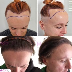 Résultats avant et après greffe de cheveux femme à Hair Clinic PRIVÉ – ligne capillaire restaurée