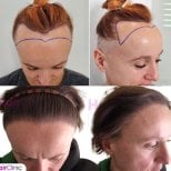 Résultats avant et après greffe de cheveux femme à Hair Clinic PRIVÉ – ligne capillaire restaurée