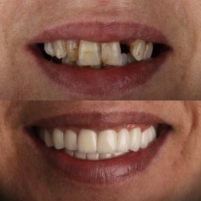 before-after photo dental-implant