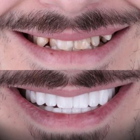 before-after photo dental-implant