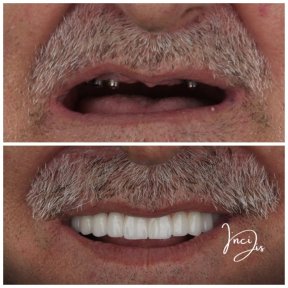 before-after photo dental-implant