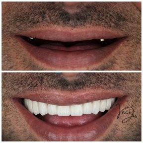 before-after photo dental-implant