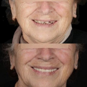 before-after photo all-on-4-dental-implants