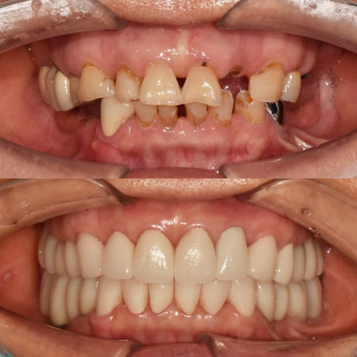 نتيجة قبل وبعد زراعة الأسنان All-on-6 في 365 Seoul OneTop Dental Clinic، استعادة الابتسامة الكاملة