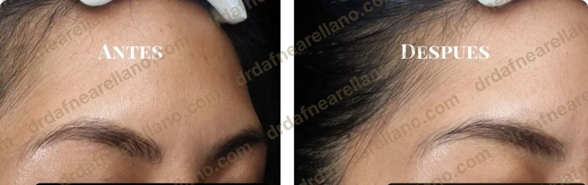 Resultados antes y después de dermoabrasión Hydrafacial – piel de frente más suave